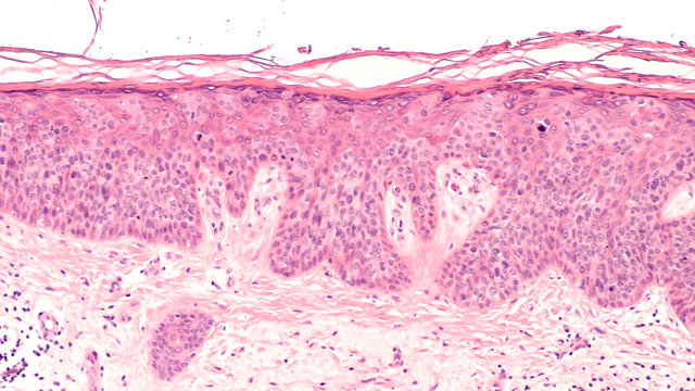 Cancer of Sun Damaged Skin: In squamous cell carcinoma in situ ("Bowen's disease"), malignant cells are confined to the epidermis, without invasion.  Regular use of sunscreen can be preventative. 