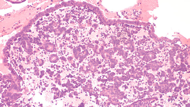 Photomicrograph Of An Endometrial Biopsy In A Woman With Abnormal Vaginal Bleeding (dysfunctional Uterine Bleeding) Showing Glandular And Stromal Breakdown.  