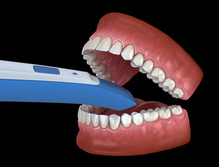 Intraoral Teeth 3D scanner. My own design. 3D illustration concept
