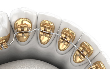 Lingual braces system. 3D illustration concept of golden braces