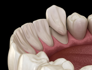 Preparated canine tooth for dental crown placement. Medically accurate 3D illustration