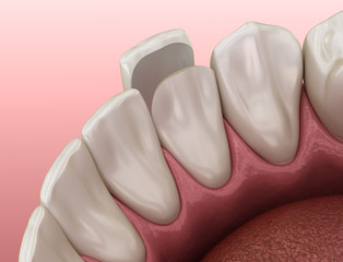 Mandibular Veneer installation procedure over lateral incisor. Medically accurate tooth 3D illustration