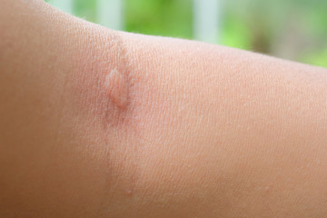 Fototapeta premium burning skin that rashes from mosquito bites