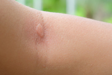 burning skin that rashes from mosquito bites