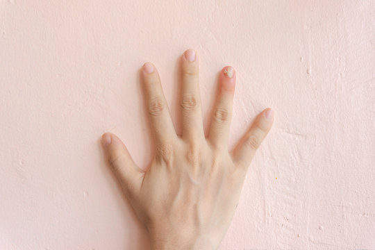 Close up of nail fungus infection on the ring finger. Human hand suffering from fungus infection. Onychomycosis with fungal nail infection on nail over soft pink pastel background.