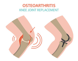 Arthritis, osteoarthritis medical infographic design. Joint replacement, implantant.