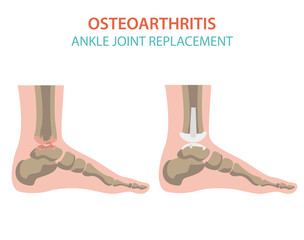 Arthritis, osteoarthritis medical infographic design. Joint replacement, implantant.