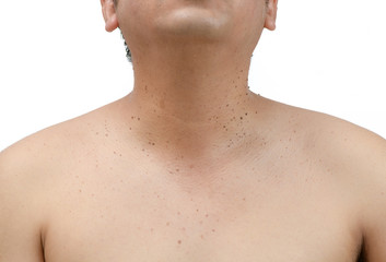 Naklejka premium Closed up the skin tags or Seborrheic Keratosis on neck