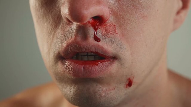 Close-Up of Man Real Nose Bleeding.