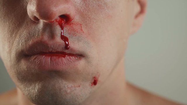 Close-Up of Man Real Nose Bleeding.