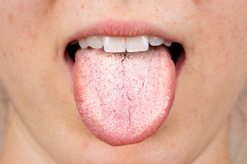 A close up view on the white furry tongue of a young Caucasian girl. A common symptom of a candida...