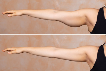 A before and after view of a young Caucasian lady who had a brachioplasty. Popular arm lift surgery...
