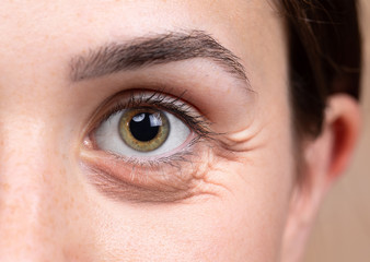 A close up view on the eye of a thirty something Caucasian lady with brownish green eyes. A puffy...