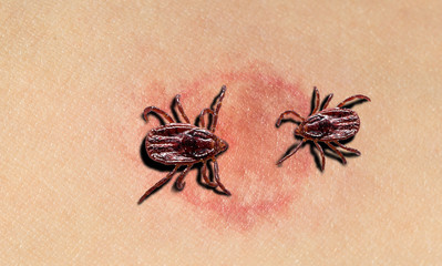 A close up view of a painful, red and inflamed tick bite with two small ticks burrowing into human skin.