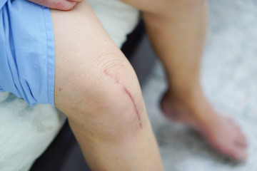 Asian senior woman patient show her scars surgical total knee joint replacement Suture wound...