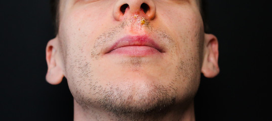Naklejka premium Herpes virus under the nose. Cold sore after the flu. Medical photo. Disease treatment.