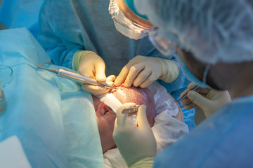 Baldness treatment. Hair transplant. Surgeons in the operating room carry out hair transplant...