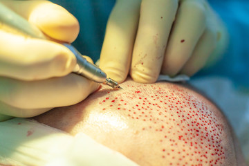 Patient's head close-up. Baldness treatment. Hair transplant. Surgeons in the operating room carry...