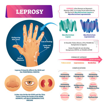 Leprosy vector illustration. Labeled medical bacterial infection disease.