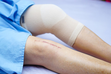 Asian senior or elderly old lady woman patient show her scars surgical total knee joint replacement Suture wound surgery arthroplasty on bed in nursing hospital ward : healthy strong medical concept.