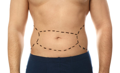 Young man with marks on belly for cosmetic surgery operation against white background, closeup