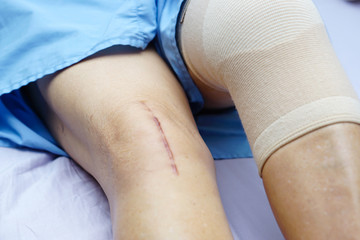 Asian senior or elderly old lady woman patient show her scars surgical total knee joint replacement Suture wound surgery arthroplasty on bed in nursing hospital ward : healthy strong medical concept.