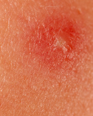 Little wound on human skin