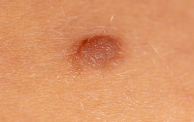 Birthmark on human skin as a background