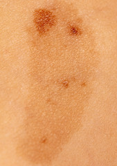 Birthmark on human skin as a background