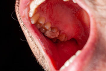 temporary filling of a tooth caries patient