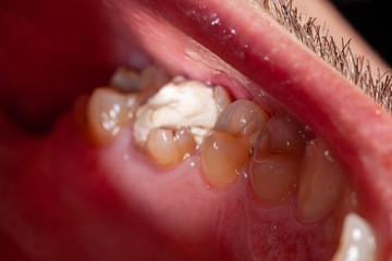 temporary filling of a tooth caries patient