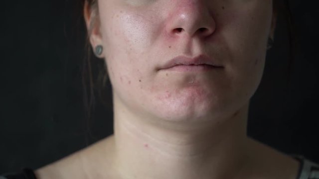 Close-up of a young woman's face. Problem skin with enlarged pores, acne. The concept of caring for problem skin, aging, environmental effects on the skin.