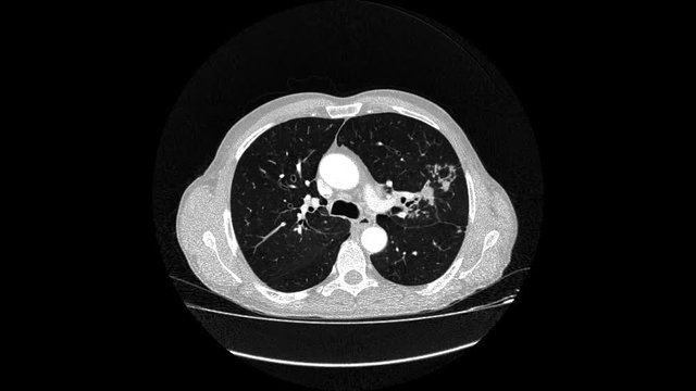 Tuberculosis radiology live MRI scan in x ray film form