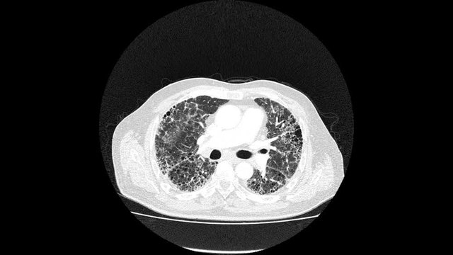 Magnetic resonance imaging lungs interstitial fibrosis