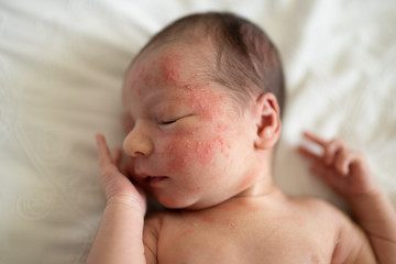 infant baby newborn gil bad case of acne  - 278749748