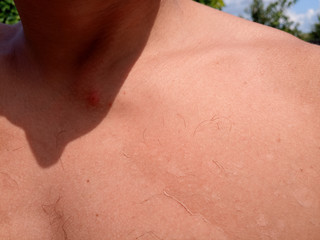 effects of sunburn on the skin. Climb skin.