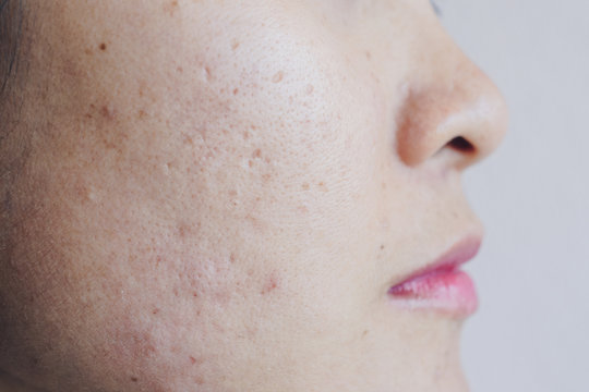 Close up of Asian woman face has problems with skin on her face. Problems with acne and scar on the female skin.