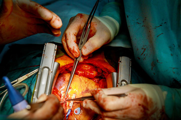 Surgeons working with a scissors on a patient in a operating theater