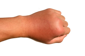 Inflammation, swelling, redness of the hand shows infection. Insect bites. Cellulitis at left hand...