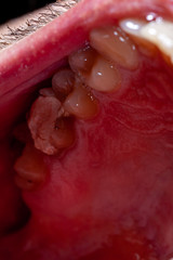 temporary filling of a tooth caries patient