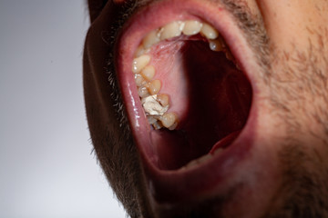 temporary filling of a tooth caries patient