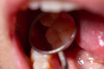 temporary filling of a tooth caries patient