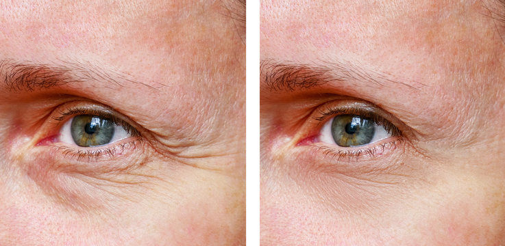Procedure for the rejuvenation of wrinkles around the eyes, crow's feet,  before and after effect