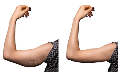 Arrows show the before and after results of a successful brachioplasty, a surgical procedure to...