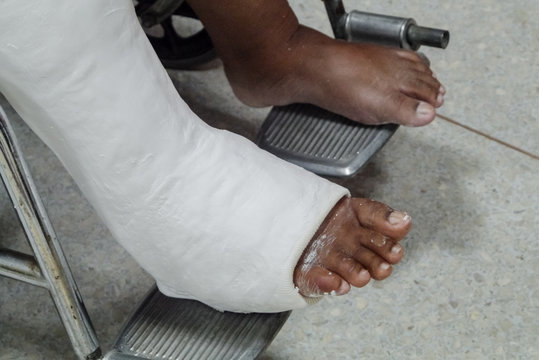 Patients with broken legs and splints for treatment.