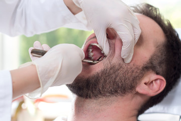 Biały mężczyzna siedzi na fotelu dentystycznym z szeroko otwartymi ustami. Dłonie stomatologa w białych rękawiczkach chwytają zęba kleszczami. Ekstrakcja zęba u białego mężczyzny.  - obrazy, fototapety, plakaty