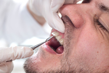 Końcówka ekskawatora dotyka szczeliny między zębowej podczas przeglądu zębów u stomatologa. Twarz białego mężczyzny z lekkim zarostem leży na fotelu podczas badania.  - obrazy, fototapety, plakaty