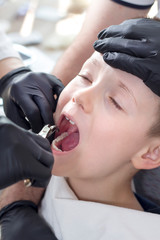 Otwarte usta chłopca podczas zabiegu ekstrakcji zęba. Asystent trzyma głowę pacjenta a lekarz trzyma w dłoni kleszcze i zbliża je do chorego zęba. - obrazy, fototapety, plakaty