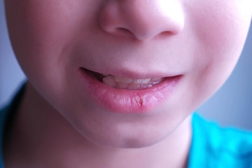 Little cracked cut on boy's lip. Child boy with herpes sore on the lip, mouth closeup. Process of dehydration during illness.