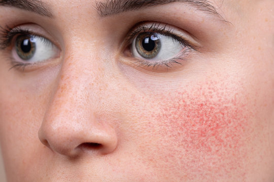 A detailed view on the soft cheek of a Caucasian woman in her early twenties. Blushing and redness is seen with superficial blood vessels, suggestive of rosacea.